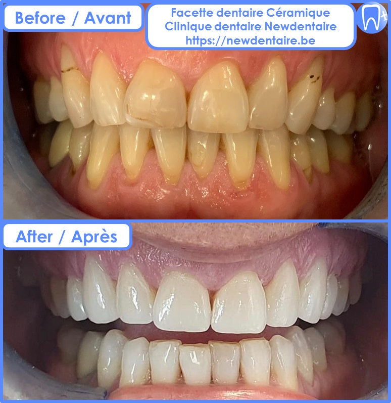 Meilleures Bandes De Blanchiment