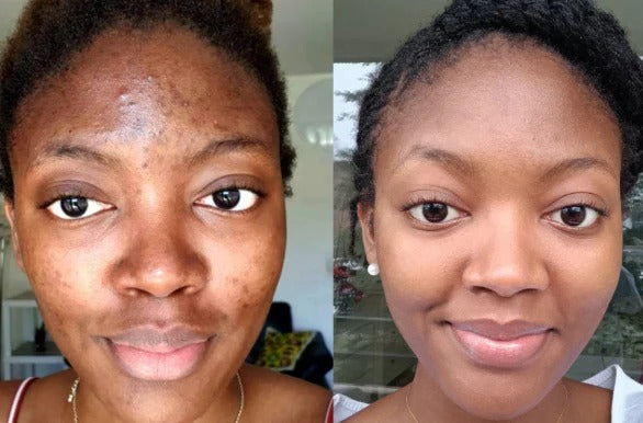 🌿 Green Mask Stick -  Meilleur purifiant qui nettoie les pores et lisse la peau.