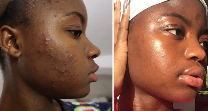 🌿 Green Mask Stick -  Meilleur purifiant qui nettoie les pores et lisse la peau.