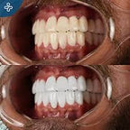 Meilleures Bandes De Blanchiment