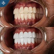 Meilleures Bandes De Blanchiment