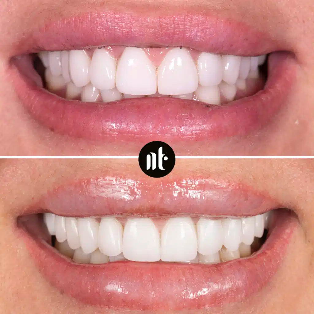 Meilleures Bandes De Blanchiment